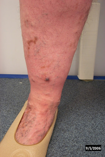 72 year old woman with recent rupture and bleeding