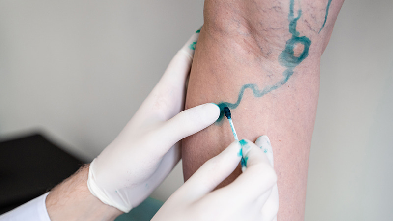 Are Varicose Veins Actually Dangerous?