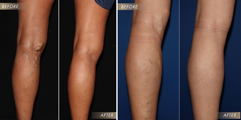 Are Varicose Veins Actually Dangerous?