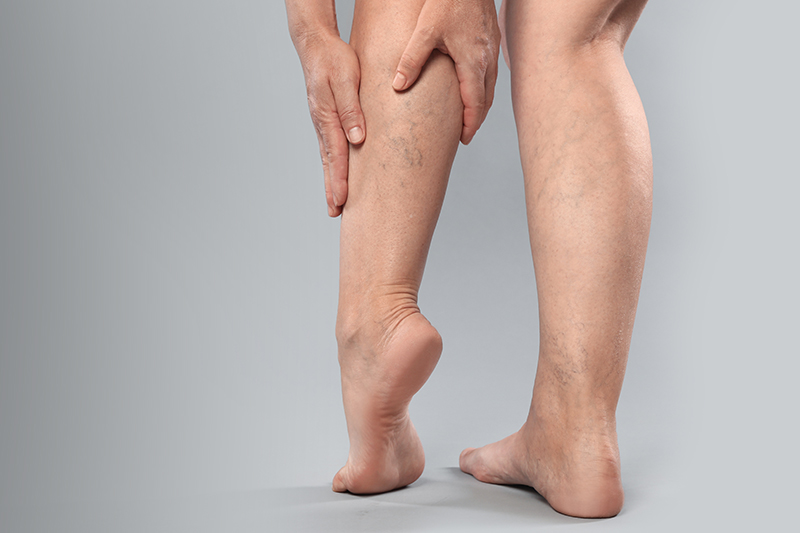 Are Vein Problems Hereditary? What You Inherit (and What You Don't)