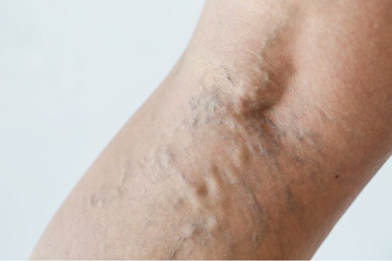 Varicose veins visible behind the knee