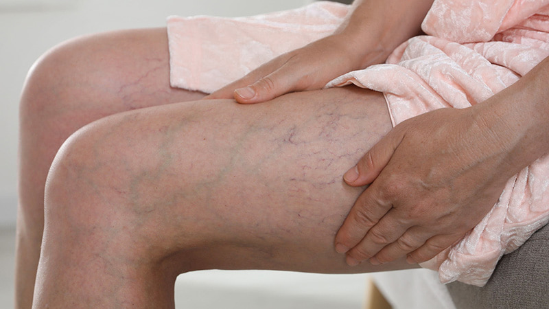 Early Signs of Chronic Venous Insufficiency: Symptoms You Shouldn’t Ignore