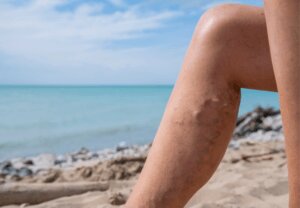 Leg with varicose veins on beach