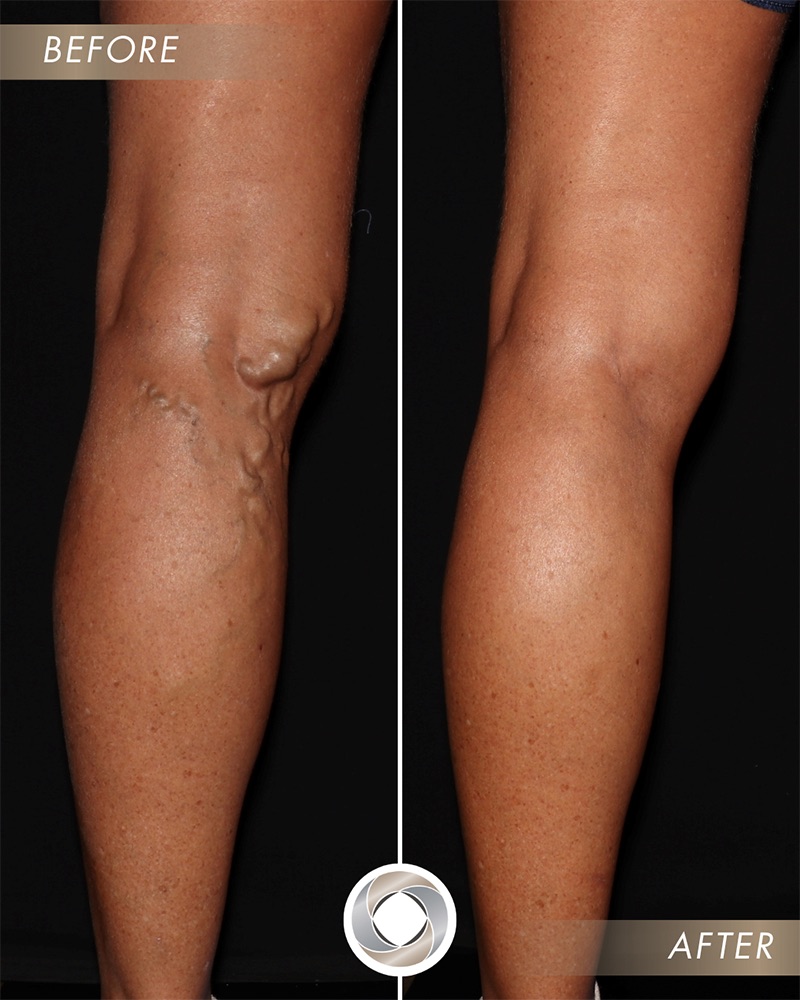 Spider and Varicose Veins 101: Causes, Symptoms, and Proven Treatments