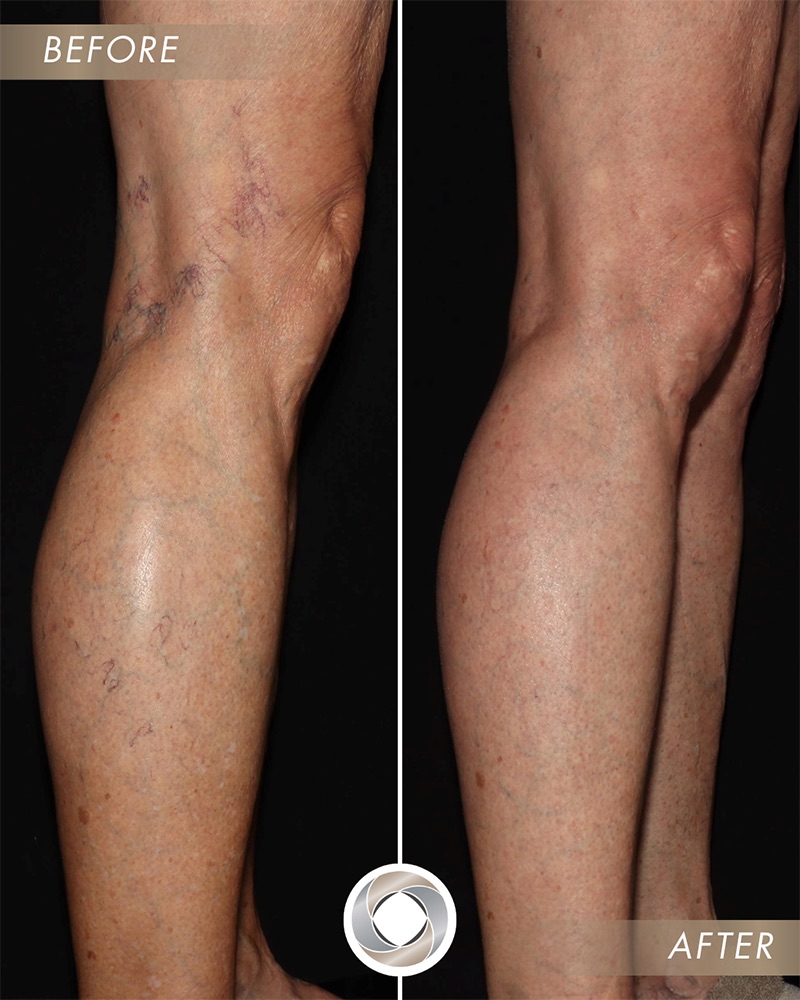 Spider and Varicose Veins 101: Causes, Symptoms, and Proven Treatments