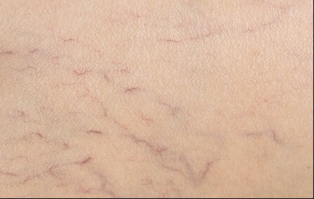 close up image of varicose veins