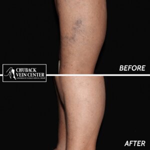 spider veins before & after image