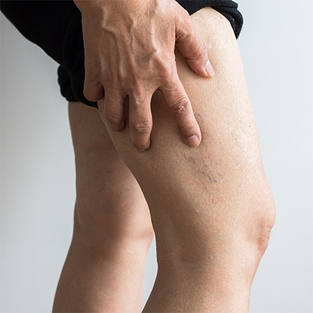 Vein Health