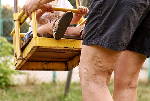 varicose veins