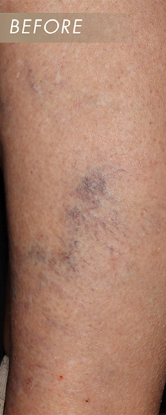 Sclerotherapy Before & After Image