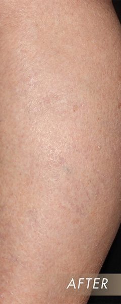 Sclerotherapy Before & After Image