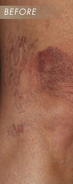 Sclerotherapy Before & After Image