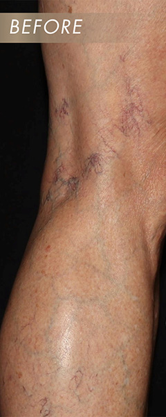 Sclerotherapy Before & After Image