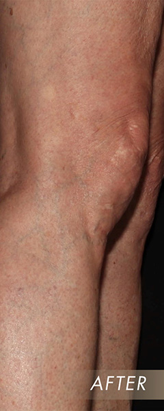 Sclerotherapy Before & After Image