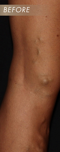 Varicose Vein Treatment Before & After Image