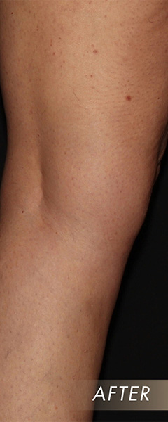 Varicose Vein Treatment Before & After Image
