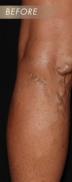 Varicose Vein Treatment Before & After Image