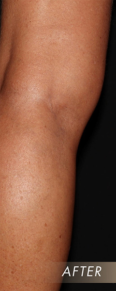Varicose Vein Treatment Before & After Image