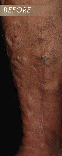 Varicose Vein Treatment Before & After Image