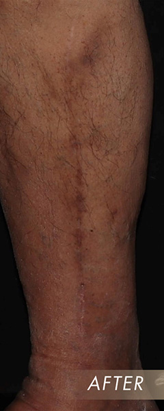 Varicose Vein Treatment Before & After Image