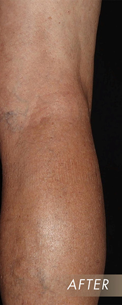 Varicose Vein Treatment Before & After Image