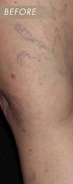 Varicose Vein Treatment Before & After Image