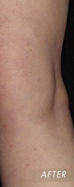 Varicose Vein Treatment Before & After Image