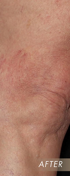 Varicose Vein Treatment Before & After Image