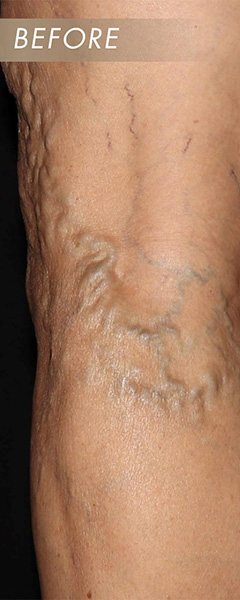 Varicose Vein Treatment Before & After Image