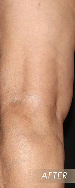 Varicose Vein Treatment Before & After Image