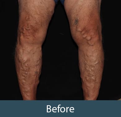 Vein Treatment Before & After Image