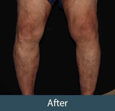 Vein Treatment Before & After Image