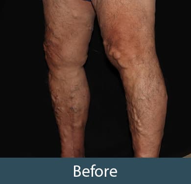 Vein Treatment Before & After Image