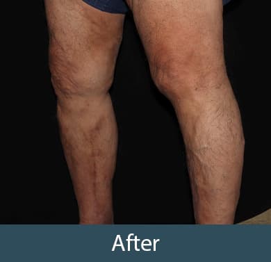 Vein Treatment Before & After Image