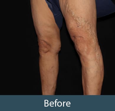 Vein Treatment Before & After Image