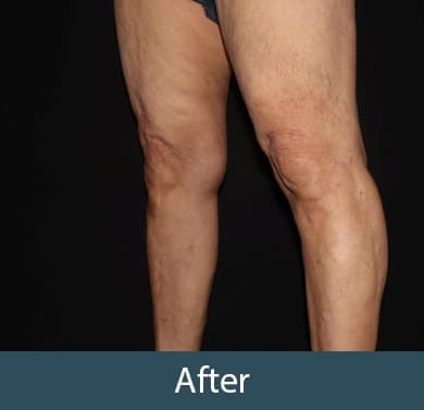 Vein Treatment Before & After Image