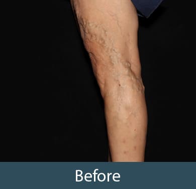 Vein Treatment Before & After Image