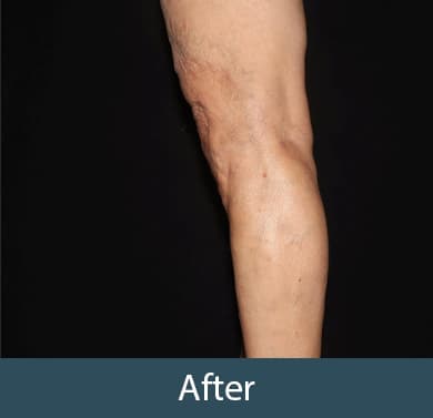 Vein Treatment Before & After Image