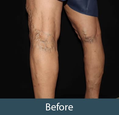 Vein Treatment Before & After Image