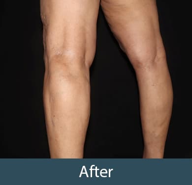 Vein Treatment Before & After Image