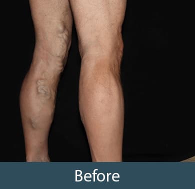Vein Treatment Before & After Image