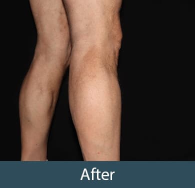 Vein Treatment Before & After Image