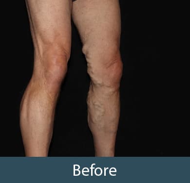 Vein Treatment Before & After Image