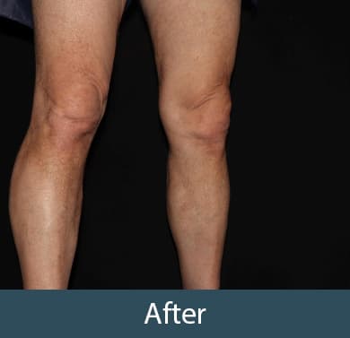 Vein Treatment Before & After Image