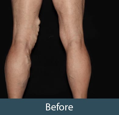 Vein Treatment Before & After Image