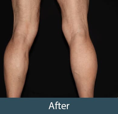 Vein Treatment Before & After Image