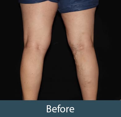 Vein Treatment Before & After Image