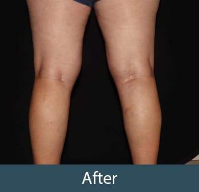 Vein Treatment Before & After Image