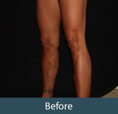 Vein Treatment Before & After Image