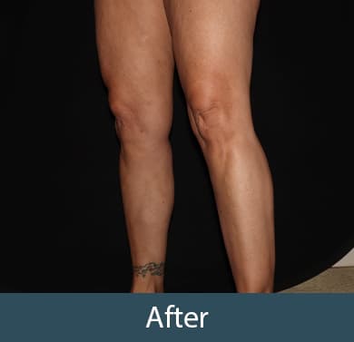 Vein Treatment Before & After Image